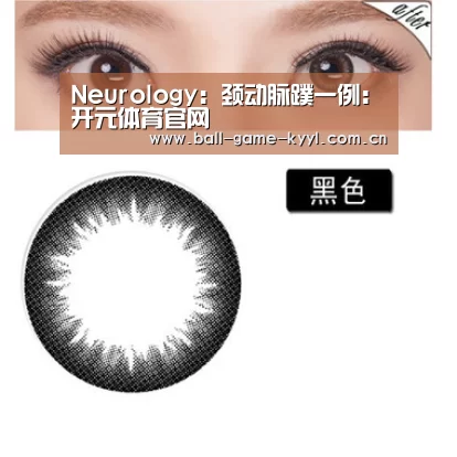 Neurology:颈动脉蹼一例:开元体育官网(图1) 开元体育入口